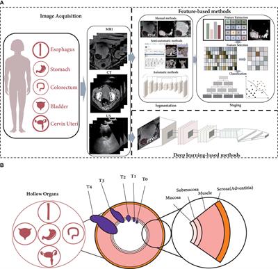 Radiomics-based T-staging of hollow organ cancers